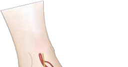 Illustration 53 for Pediatric Ankle Fractures: Management to Prevent Long-Term Issues