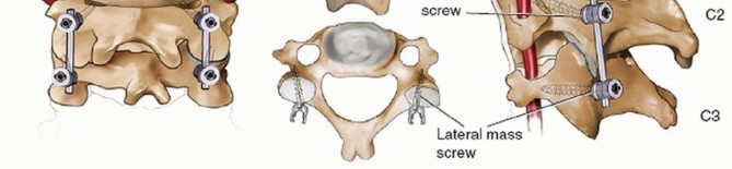 Illustration 22 for Master Techniques for Cervical Fracture Reduction: Type III & More