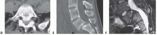 Illustration 8 for Mastering High-Grade Spondylolisthesis: Posterolateral and Interbody Fusion
