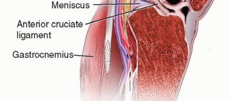 Illustration 2 for Knee Arthrodesis: A Solution for Stable Femur & Tibia Fusion
