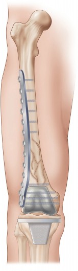 Illustration 17 for Mastering Periprosthetic Femoral Fractures Above Knee Arthroplasty