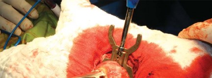 Illustration 57 for Metal on Metal Resurfacing: Enhanced Posterior Soft Tissue Repair