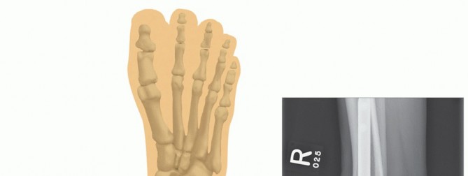 Illustration 32 for Unlock Stability: Medullary Nail Fixation for Tibiotalocalcaneal Arthrodesis