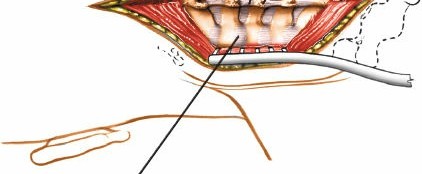 Illustration 182 for Approach to the Lumbar Spine: Mastering Techniques & Anatomy