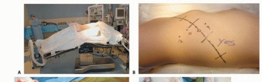 Illustration 24 for Anterior Interbody Arthrodesis for Scoliosis: What You Need to Know