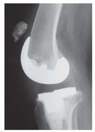 Illustration of patella tendon rupture - Dr. Mohammed Hutaif