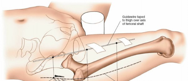 Illustration 68 for Optimal Femoral Approaches: Mastering the Lateral Intermuscular Septum