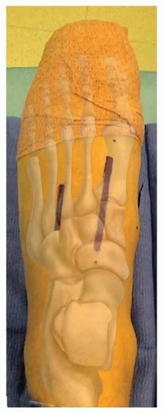 Illustration 11 for Fixation of Lisfranc Injuries: Essential Open Reduction Guide