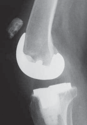 Extensor Mechanism Repair: Effective Solutions for Revision TKA