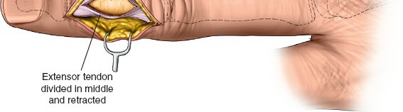 Illustration 8 for Unlock Easier Access: Dorsal Approach for Phalanges and Interphalangeal Joints