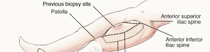 Illustration 12 for Limb-Sparing Quadriceps Resection: Superficial Femoral Artery