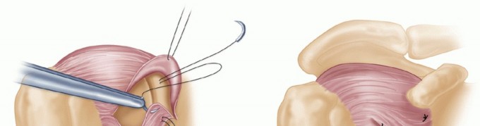 Illustration 25 for Bankart Repair & Inferior Capsular Shift: Solving Shoulder Instability