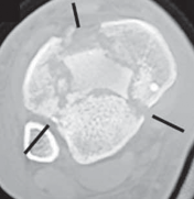 Illustration 11 for Optimizing ORIF for Tibial Plafond Fractures: A Modern Approach