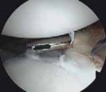 Illustration 32 for Regain Stability: Anterior Shoulder Instability Arthroscopic Fix