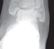 Illustration 40 for Optimizing ORIF for Tibial Plafond Fractures: A Modern Approach