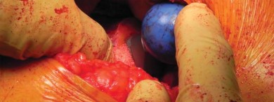 Illustration 53 for Unlock better THA: The technique of short stem for less invasiveness