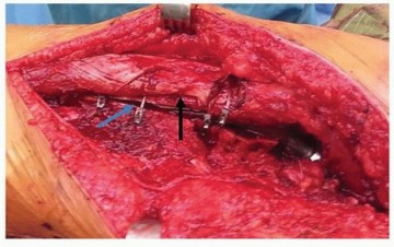 Illustration 16 for Optimizing Revision THA with Tapered Fluted Titanium Stems