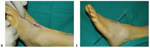Illustration 36 for Restore Movement: Tendon Transfer for Common Peroneal Nerve Foot Drop