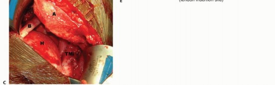 Illustration 13 for Restore Shoulder Function with Latissimus Dorsi Tendon Transfer