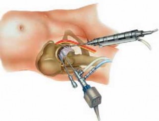 Illustration 17 for Solving Hip Soft Tissue Pathology with Advanced Arthroscopy