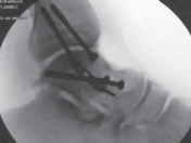 Illustration 28 for Talar Neck Fracture Treatment: Optimizing Recovery with ORIF