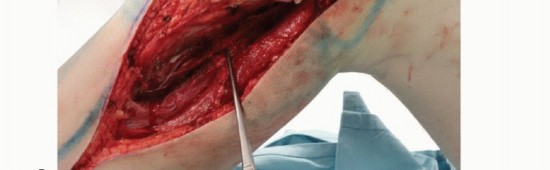 Illustration 20 for Tackling Complex Tumors of the Proximal Tibia: Limb-Sparing Solutions