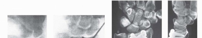 Illustration 29 for Precision Correction for Distal Radius Malunion