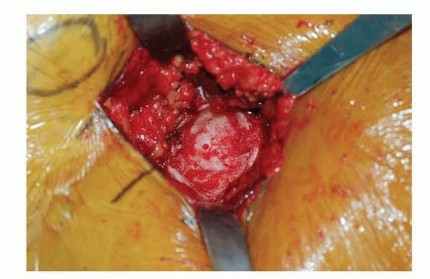 Illustration 13 for Hemiarthroplasty of the Hip: Indications & Types Explained