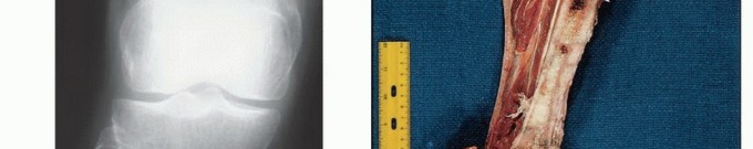 Illustration 11 for Below-Knee Amputation: Maximize Your Below-Knee Recovery & Function