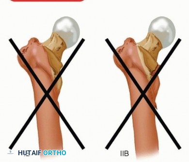 Illustration 8 for Retrograde Femoral Nailing: Optimizing Surgical Outcomes