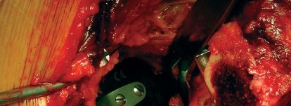 Illustration 33 for Cemented Component Longevity: The Critical Margin of the Acetabulum