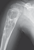 Understanding Benign Bone Cysts: Causes, Symptoms & Treatments