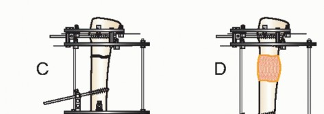 Illustration 21 for Beyond Amputation: Circular Fixation for Infection of the Talus