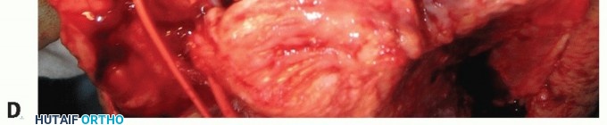 Illustration 22 for Distal Humeral Fractures: When Is Elbow Replacement the Best Option?