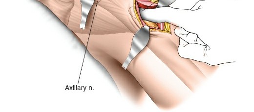 Illustration 117 for Essential Guide: Mastering Every Approach to the Shoulder