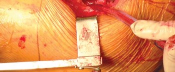 Illustration 60 for Exploring the Ambulatory Surgical Setting for Total Hip Replacement