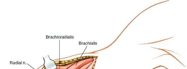 Illustration 63 for Mastering the Approach to the Distal Humerus: Safety & Skills