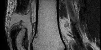 تمزق الرباط الصليبي الأمامي وإصابات الركبة المعقدة: دليل شامل من الأستاذ الدكتور محمد هطيف صنعاء