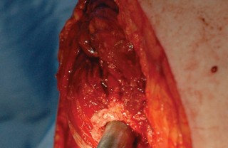 Illustration 81 for Femoral Stem Revision: Posterior Approach for Better Outcomes