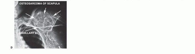 Illustration 4 for Mastering Total Scapular Resections: Reconstruction & Outcomes