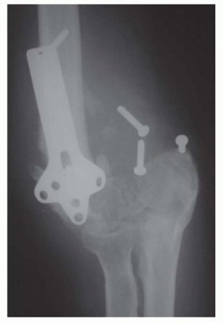 Arthroplasty for Posttraumatic Conditions of the Elbow