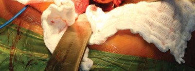 Illustration 72 for Metal on Metal Resurfacing: Enhanced Posterior Soft Tissue Repair