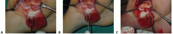 Illustration 17 for Unlock Healing: Medial Malleolar Osteotomy for Talus OLT Allografts