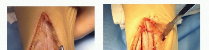 Talus Anterior Tibial Osteotomy: Achieve Stable Healing