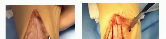 صورة توضيحية لـ الشفاء من آلام الكاحل: الحل المتقدم لإصابات غضروف العرجون (Anterior Tibial Osteotomy)