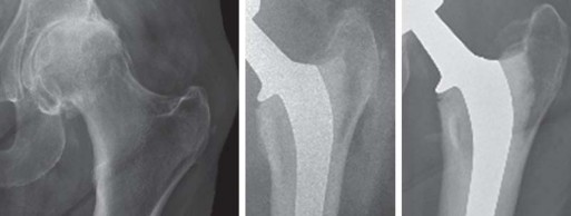 Illustration 39 for Mastering Cementing Technique Femur: A Step-by-Step Guide