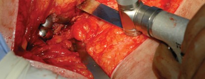 Illustration 74 for Femoral Stem Revision: Posterior Approach for Better Outcomes