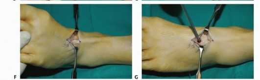 Illustration 37 for Foot Drop Surgery: How a Pin or Drill Elevates Tendon Transfer