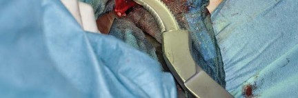 Illustration 47 for Collum Femoris Preserving: Achieve Better Primary Hip Outcomes