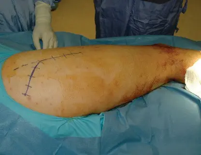 مراجعة جذع الفخذ عبر النهج الخلفي: حلول متقدمة لنتائج أفضل مع الأستاذ الدكتور محمد هطيف